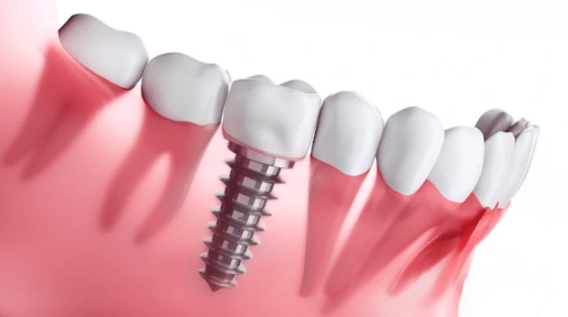 Trụ Implant Hàn Quốc ngày càng được đánh giá cao nhờ chất lượng ổn định và giá thành hợp lý