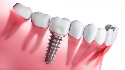 5 hiểu lầm thường thấy về trồng răng Implant