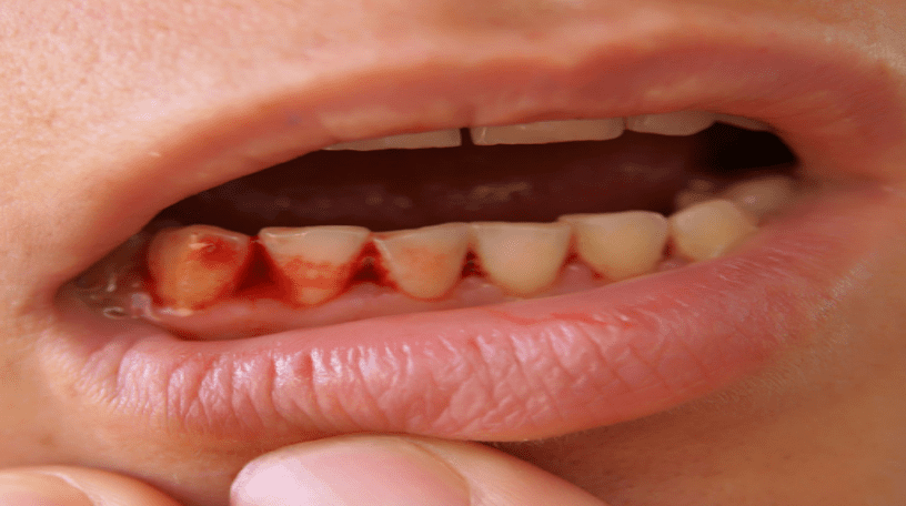 Cần điều trị khỏi các vấn đề về răng miệng trước khi cấy ghép Implant để đảm bảo kết quả tốt nhất